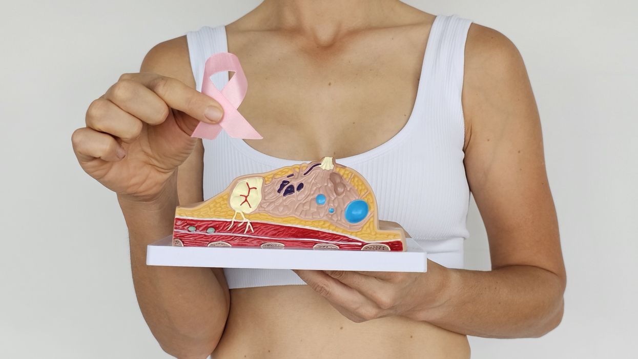 Capivasertib: New NHS Pill Slows Incurable Breast Cancer Progression