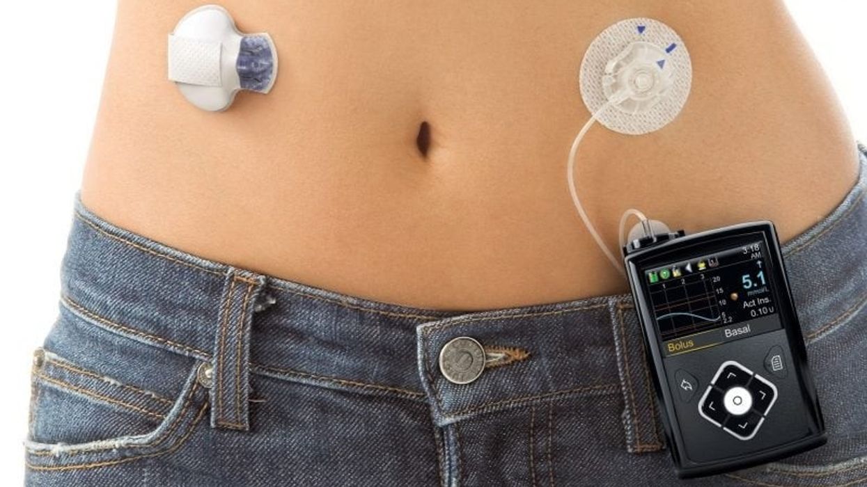 NHS: Nearly 900 patients with type 1 diabetes benefit from ‘artificial pancreas’