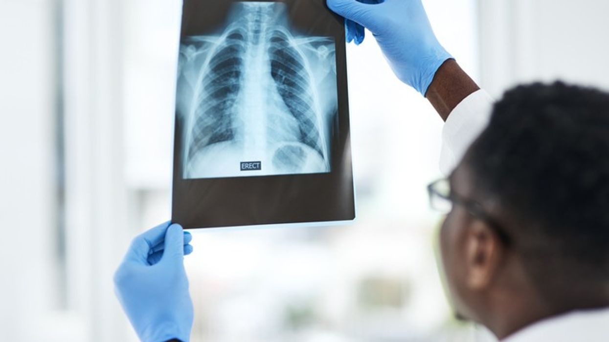 UK-Asian medics discover breakthrough treatment to cure lung damage in Covid-19