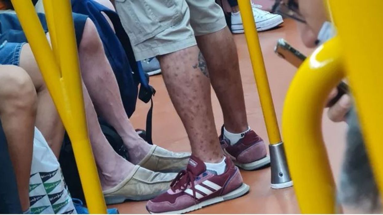 Man with ‘Monkeypox symptoms' photographed on packed train in Spain