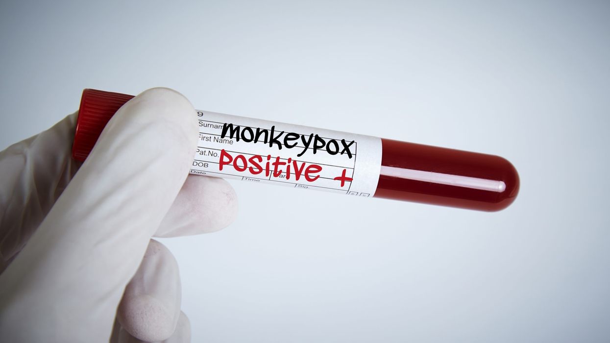 Monkeypox infection may cause serious heart issues – Study