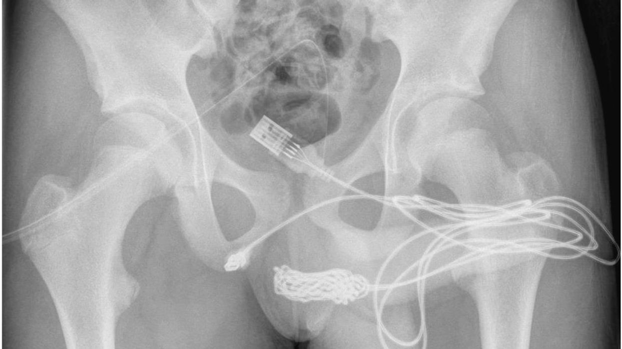 Boy, 15, gets USB cable stuck in his genitalia – forced to have surgery