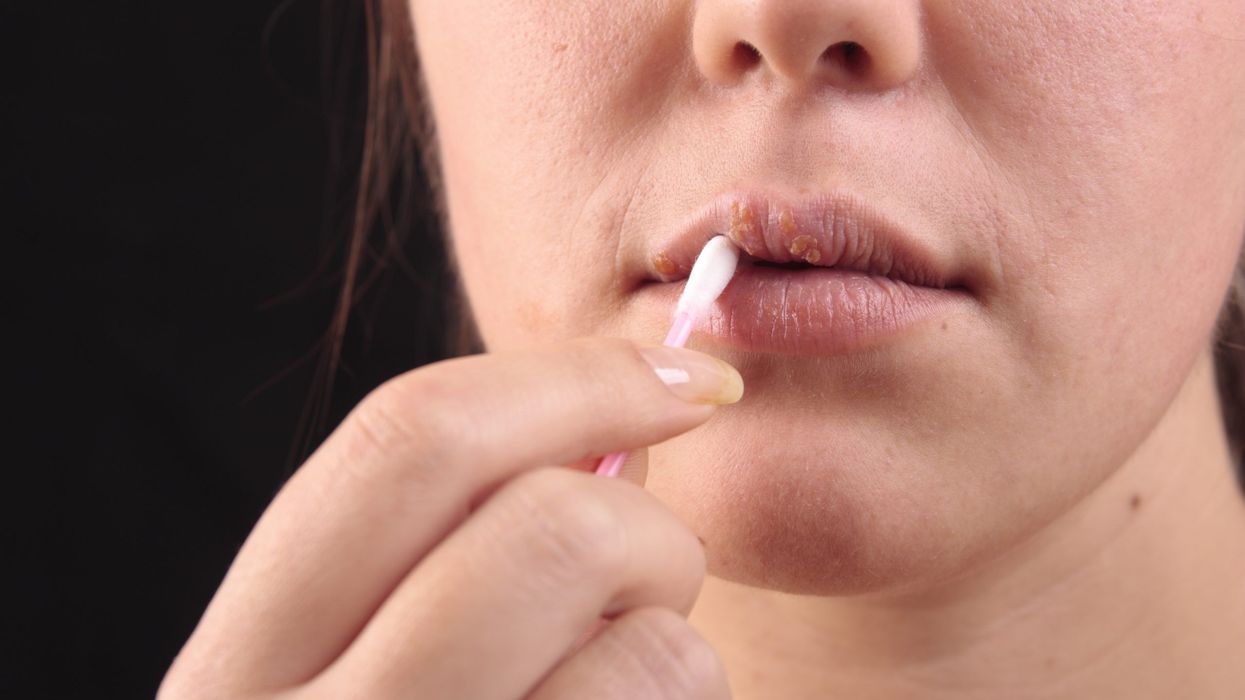 These symptoms on your face and lips may indicate the deficiency of this vitamin