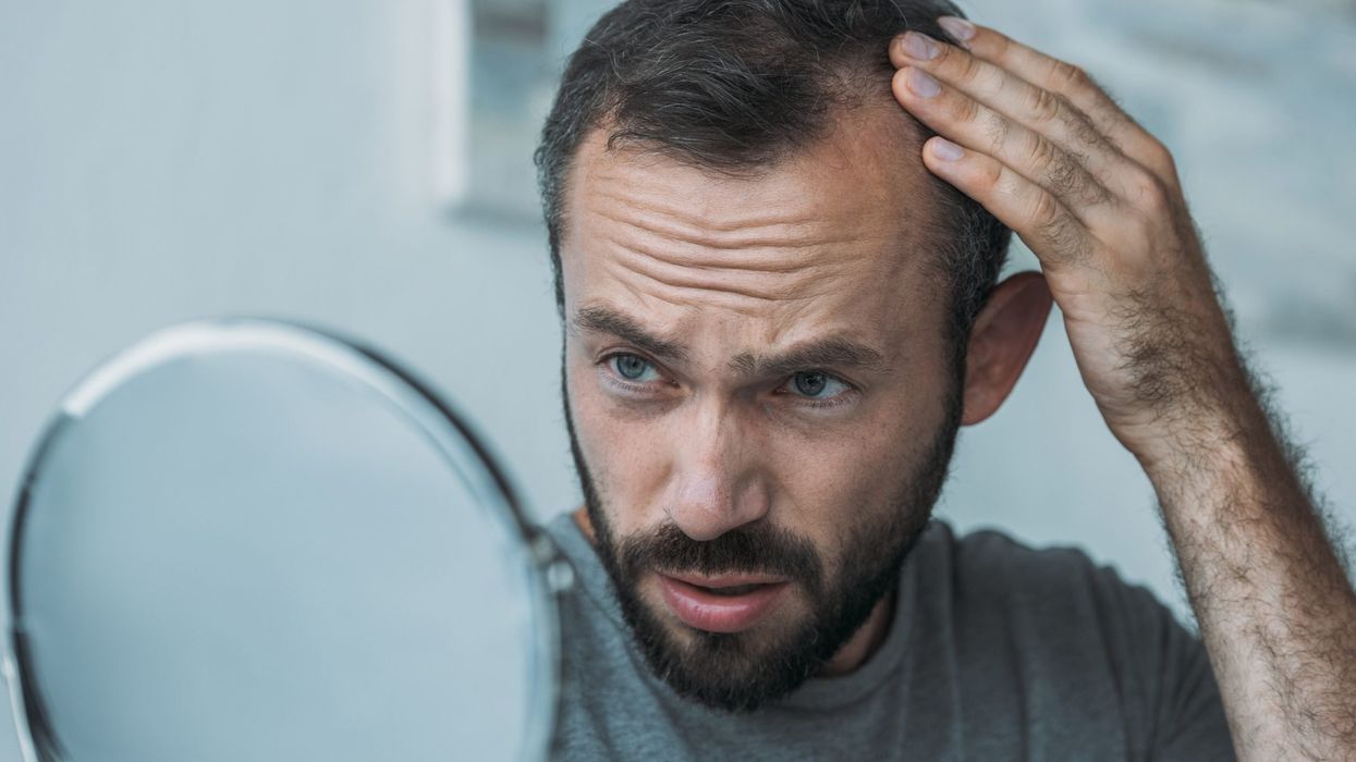 Baldness linked to increase risk of heart disease