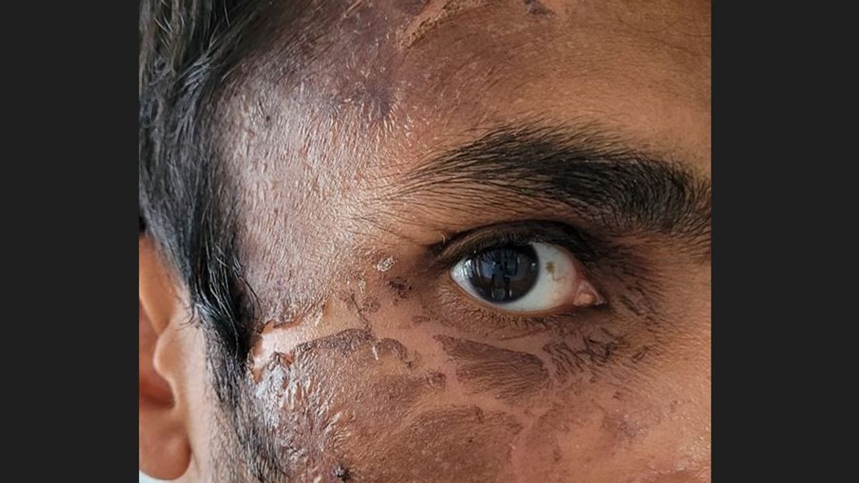 Racist thug avoids jail for throwing scalding hot water in officer's face; Met Police livid