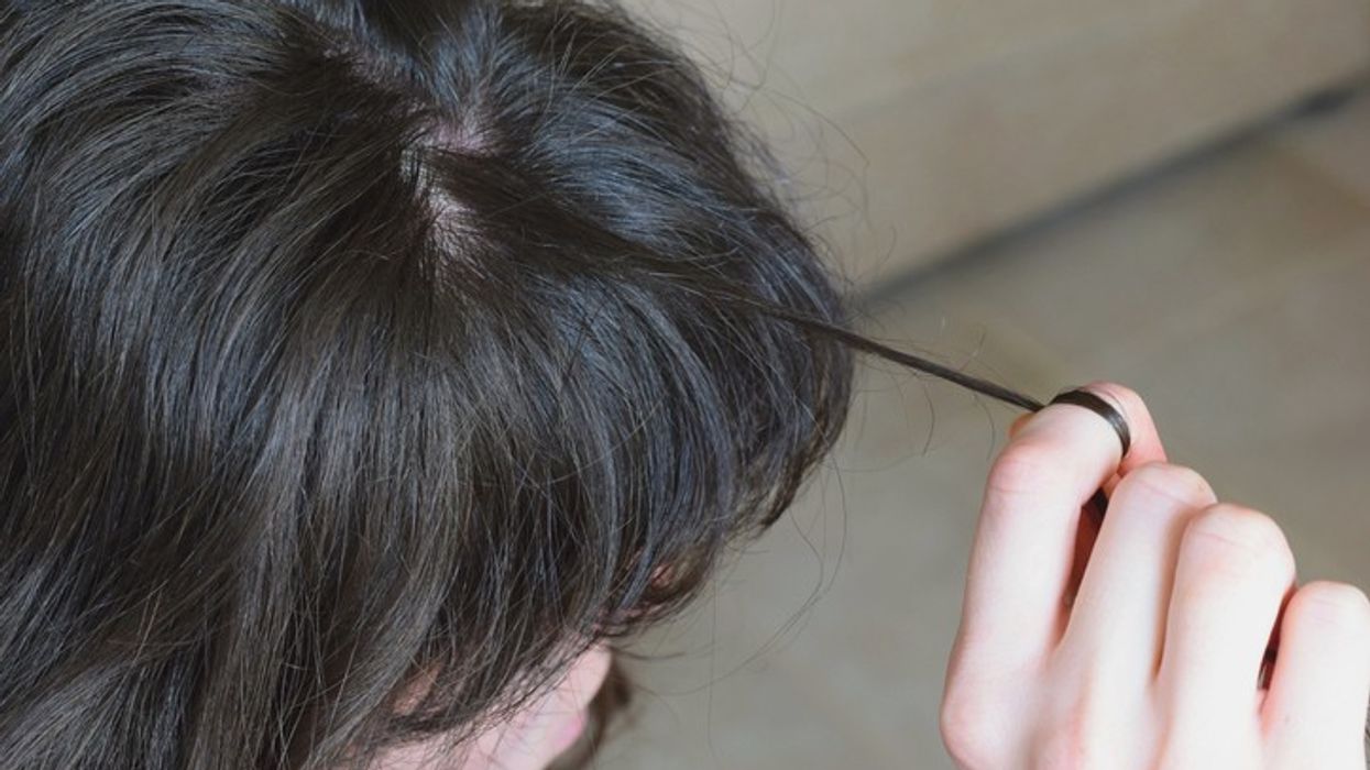 Young woman dreams of 'full head of hair' but in reality she has trichotillomania – Know all about this hair-pulling disorder
