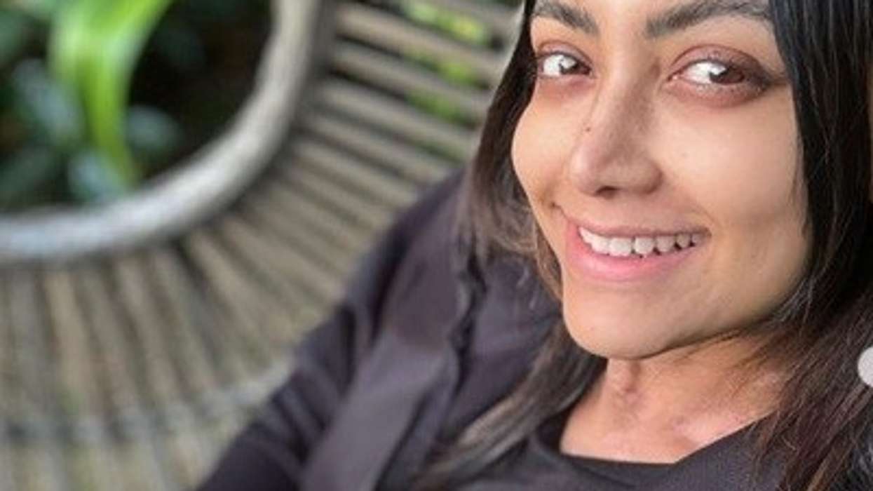 Indian actor Mamta Mohandas diagnosed with vitiligo – All you need to know about this disease