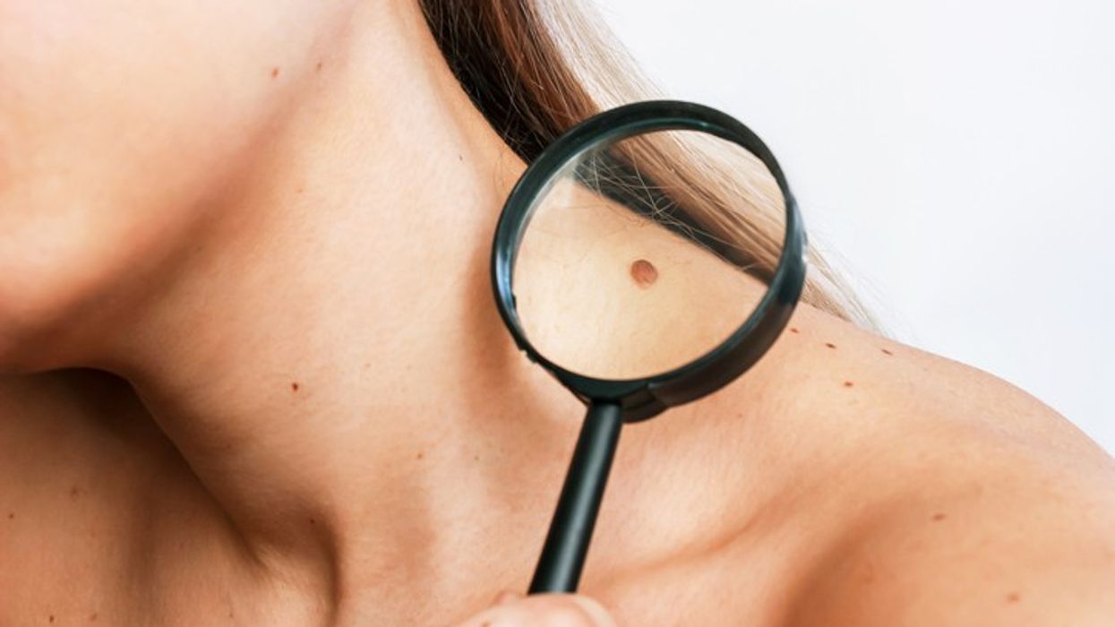 Shocking! 21-year-old's growing mole turns out to be cancer