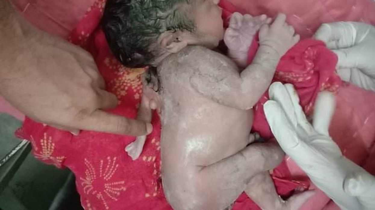 Unusual birth: Baby in India born with third arm protruding from its back