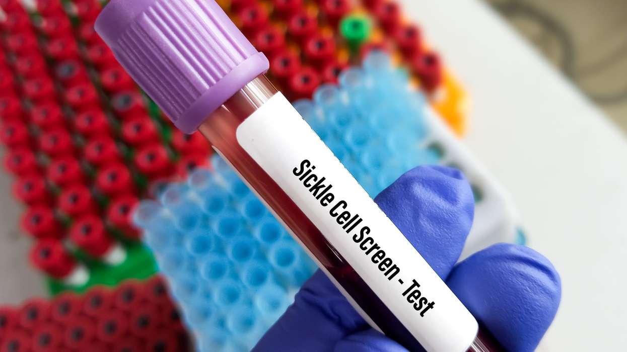 Sickle cell anaemia 11 times deadlier than previous estimates: Study