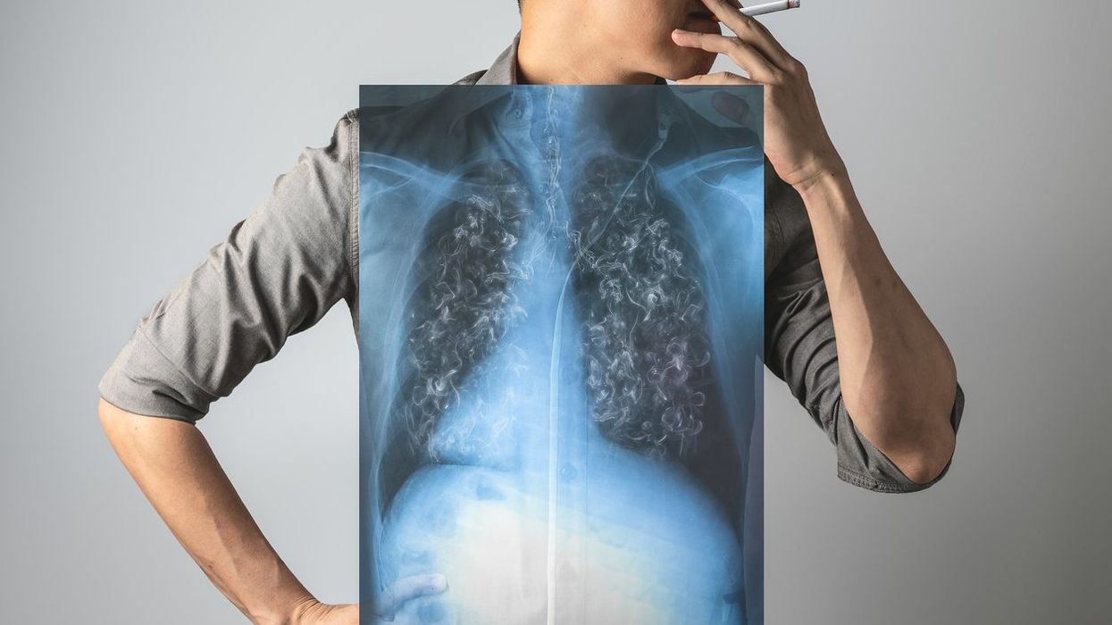 Long-term smokers show symptoms not meeting smoking-related disease criteria: Study