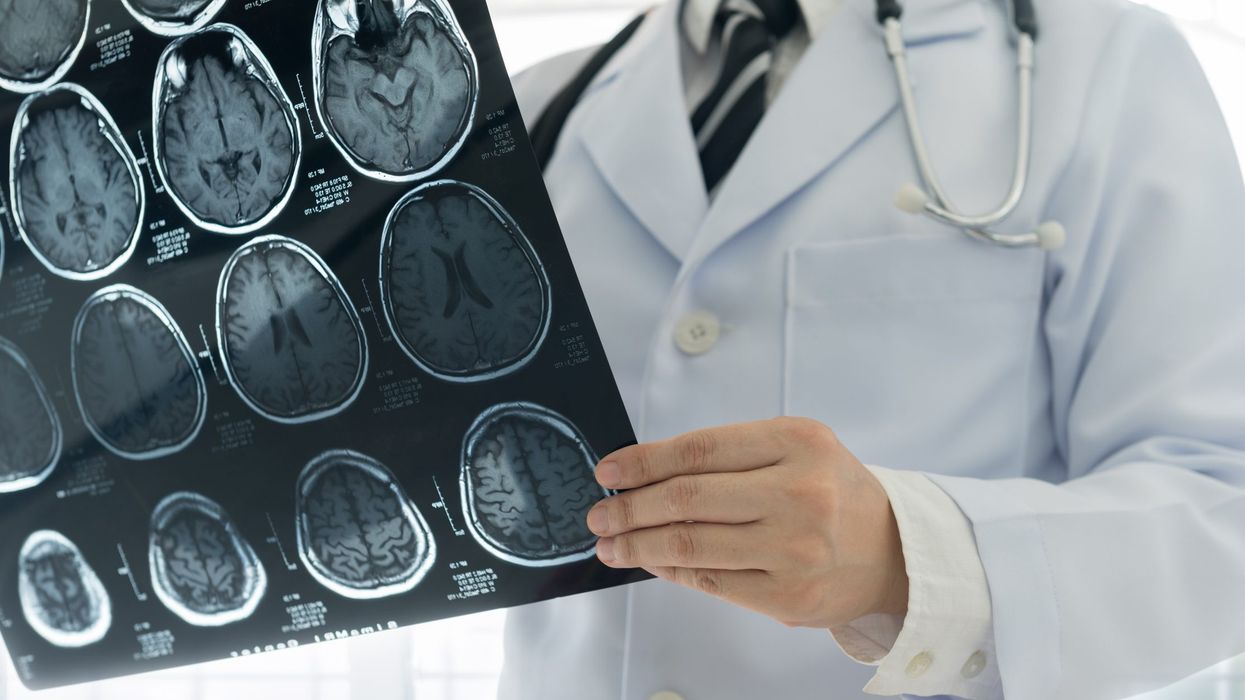 Diabetes linked to functional, structural brain changes: Study