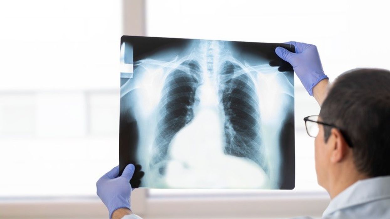 India, Pakistan top countries of origin for non-UK TB cases