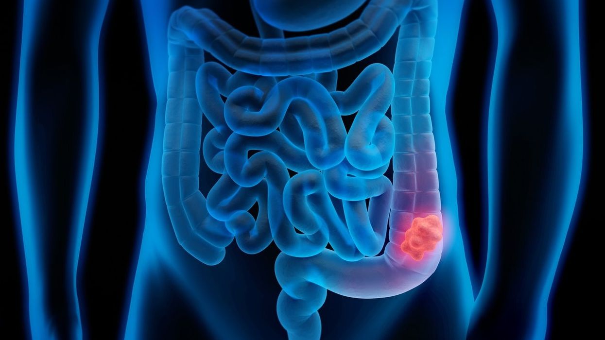 Mouth bacteria linked to colon cancer growth, says study