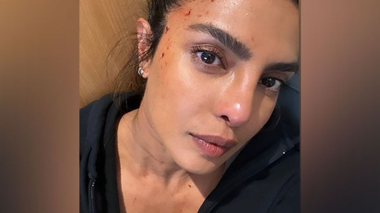 Priyanka Chopra shares photo of ‘bloodied’ forehead from 'Heads of State' set