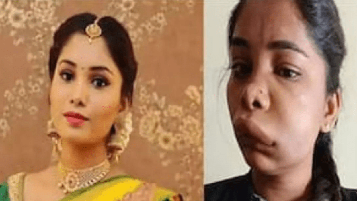 Kannada actor Swathi Sathish looks unrecognisable after her root canal surgery goes horribly wrong