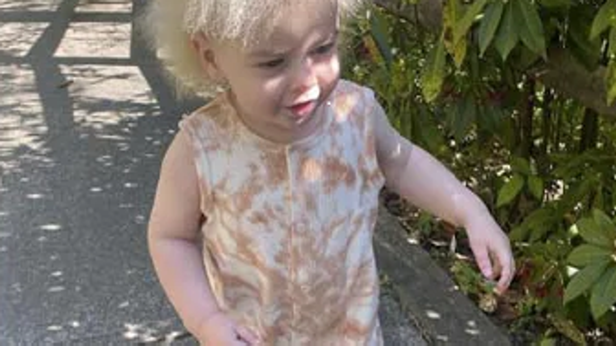 This toddler has 'Uncombable Hair Syndrome' which leads to dry and frizzy hair like Einstein, deets inside