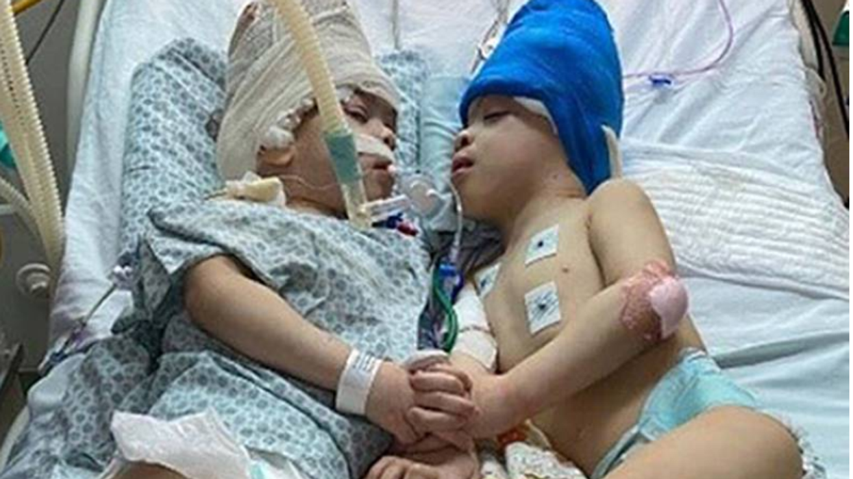 British Asian paediatric neurosurgeon separates Brazilian conjoined twins with fused brains