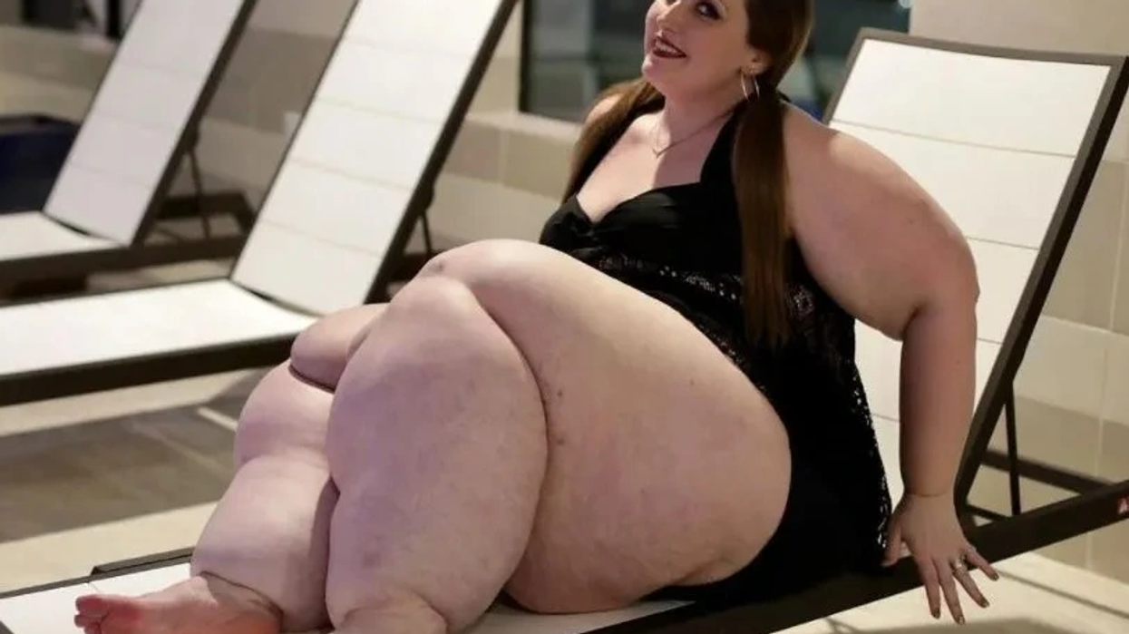 Doctors tell woman her huge legs are due to 'obesity'– failed to diagnose her medical condition