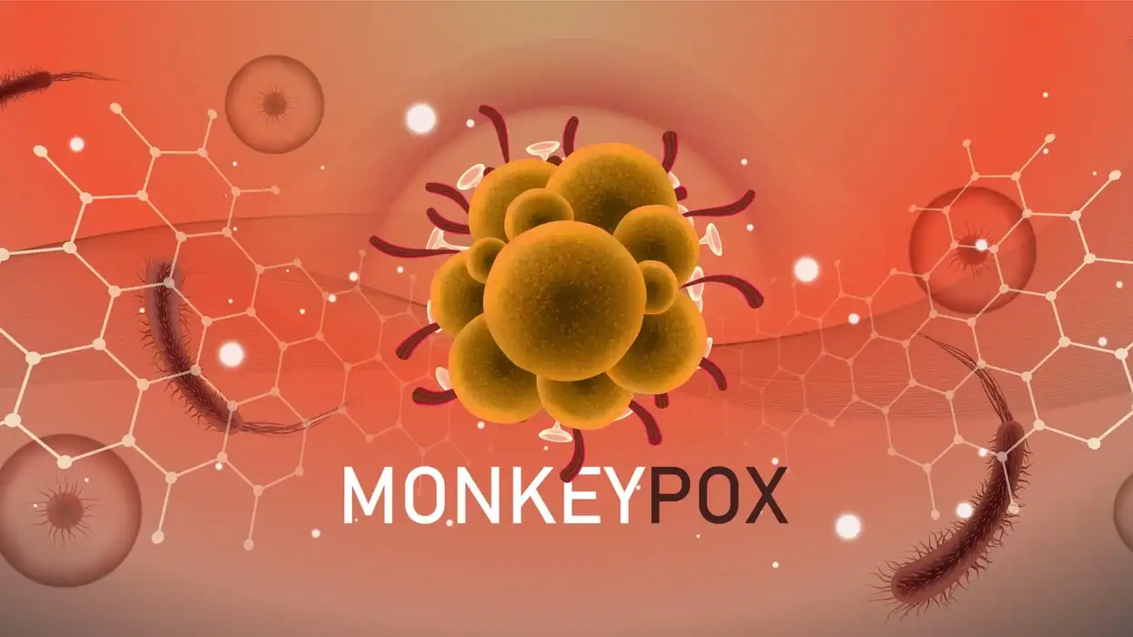 Monkeypox vs. Chickenpox: What is the difference between the two?