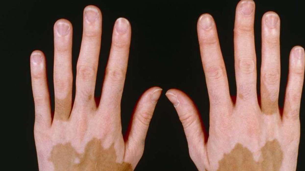 vitiligo